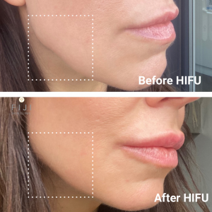 Hifu before and after on jaw line