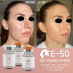 exsomes face before after