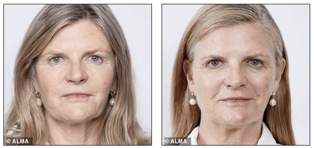 Susannah Constantine Harmony Bio-Boost Before and After using Alma Harmony at Fiji Skin Clinic