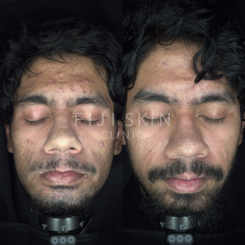 active acne, inflammation and acne scarring before and after fiji skin clinic on dark skin asian skin