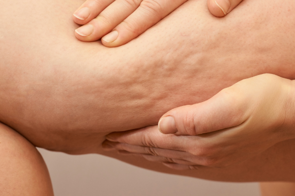 Cellulite