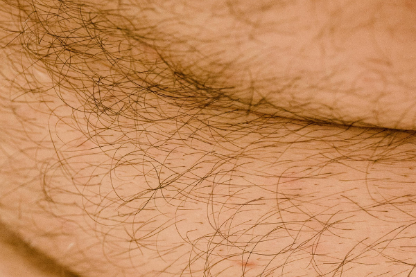 Excess Hair
