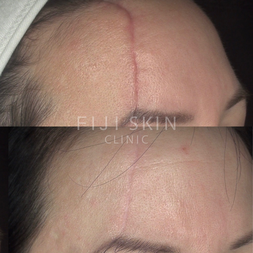 deep scarring before and after fiji skin clinic face scar
