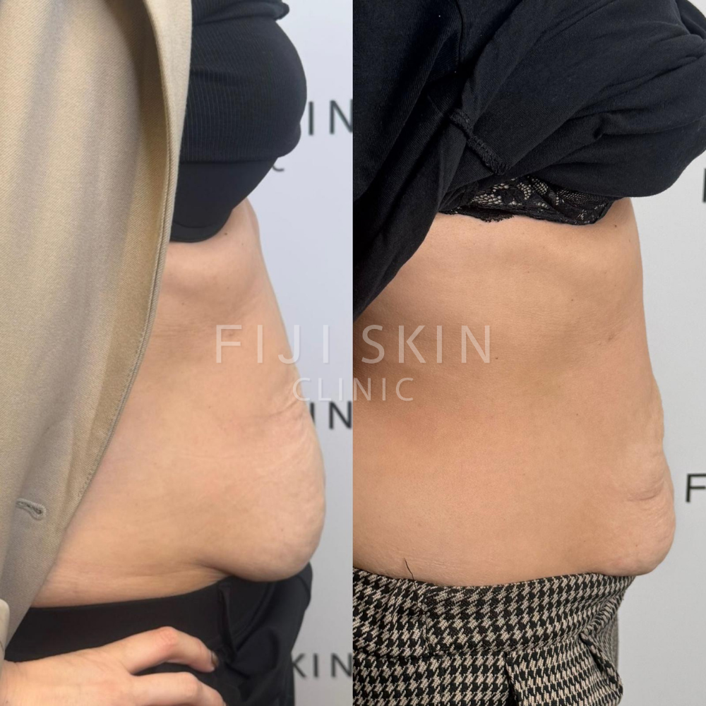 loose skin and stomach fat before and after fiji skin clinic