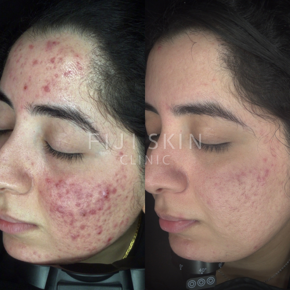 acne and redness before and after fiji skin clinic asian skin brown skin